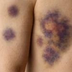 blaue Flecken bei Leukämie